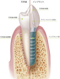 天然歯とインプラントの比較