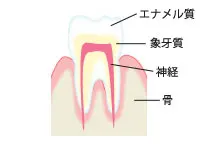 初期虫歯の状態
