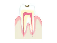 歯の表面のエナメル質にだけ穴が開いた状態