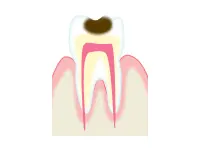 エナメル質の下にある象牙質にまで達した虫歯