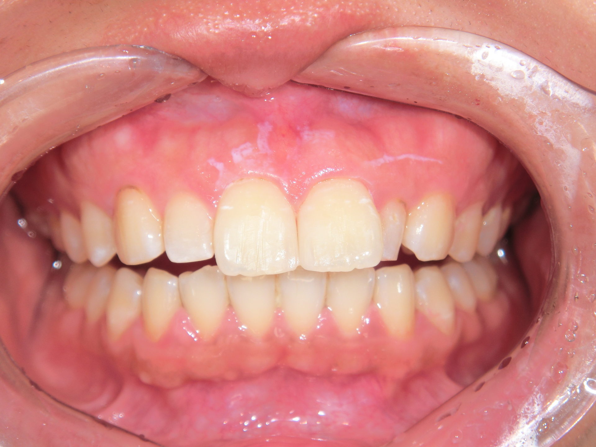 ダイレクトボンディング　～前歯の隙間～