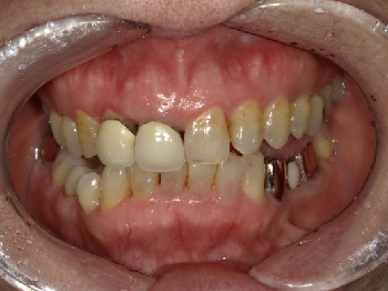 セラミックによる審美治療　～右上前歯～