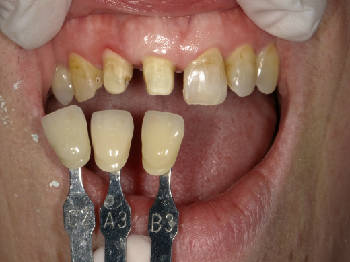 セラミックによる審美治療　～右上前歯～