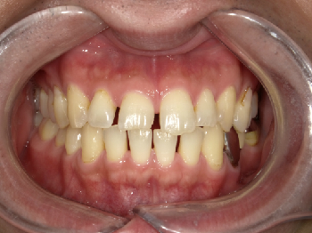 ダイレクトボンディング　～前歯の隙間～