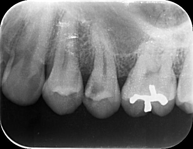 プラズマレーザー治療　～永久歯のむし歯～