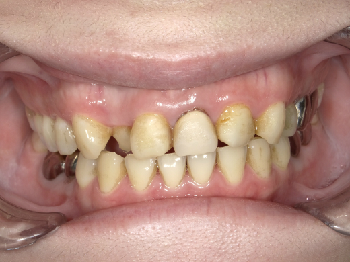 セラミックによる審美補綴治療　～上の前歯3本～
