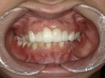 ジルコニアクラウンおよびノンクラスプデンチャーによる審美治療　～上顎前歯と臼歯～