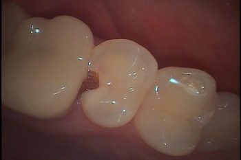 プラズマレーザー治療～永久歯のむし歯～
