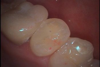 プラズマレーザー治療～永久歯のむし歯～