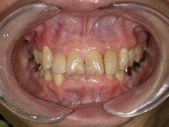 セラミックによる審美治療　～右上側切歯～