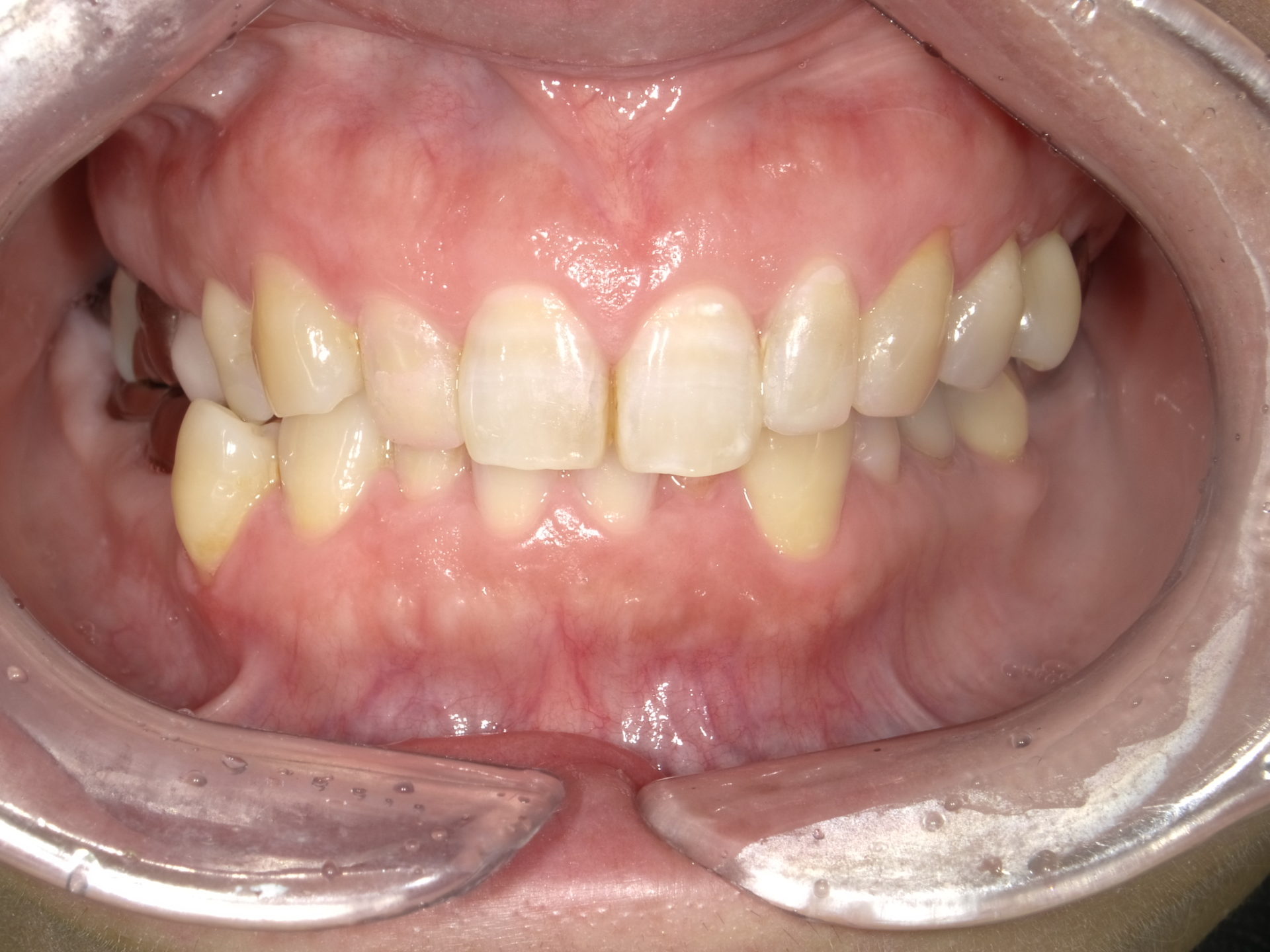 ダイレクトボンディング　～左右上顎側切歯～