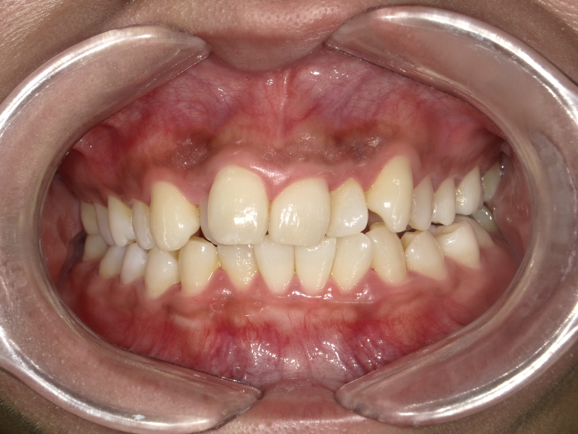 セラミックによる審美治療　上顎前歯6本