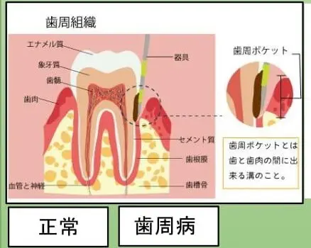 歯周病の原因と治療法 | 名古屋市北区大曽根の歯医者なら光輪歯科