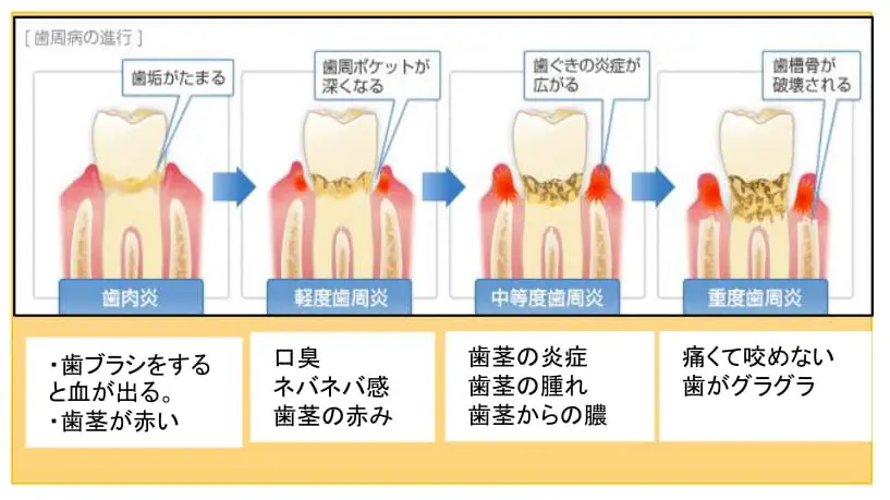 歯周病の原因と治療法 | 名古屋市北区大曽根の歯医者なら光輪歯科