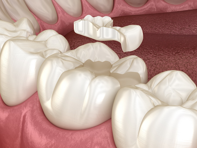 奥歯の虫歯治療後に使用する詰め物・被せ物イメージ