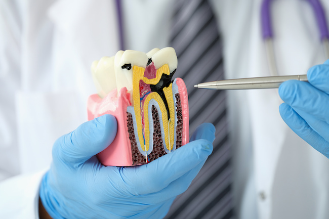 虫歯のメカニズムを説明する歯科医師