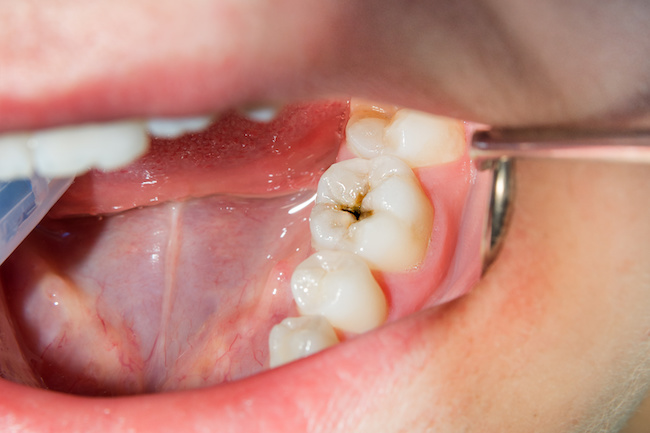 虫歯の発見