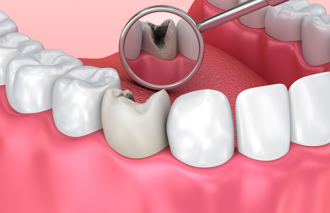 虫歯の検査