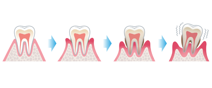歯周病の進行過程のイメージ