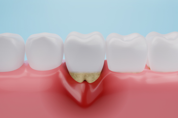 歯周病の症状のイメージ