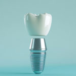 1本のインプラント