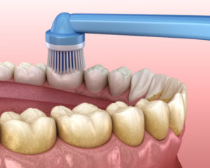 PMTCのクリーニングを受ける様子