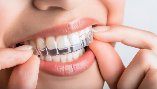 歯ぎしりを防ぐためマウスピースを装着する女性