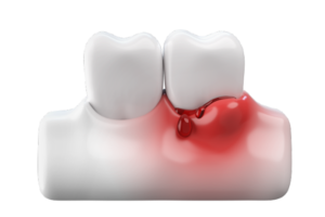 見た目でわかる歯周病の様子