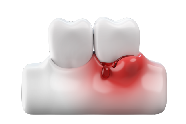 見た目でわかる歯周病の様子