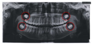親知らずが写っているレントゲン写真