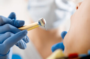 虫歯治療をする歯科医師の手元