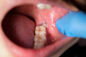 親知らずが生えた口腔内