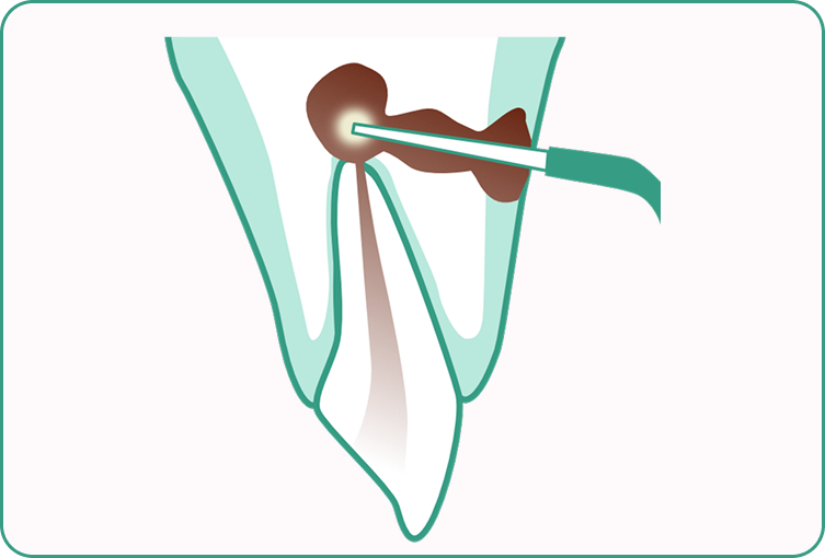 kourinshika-Nd-YAG_laser_04