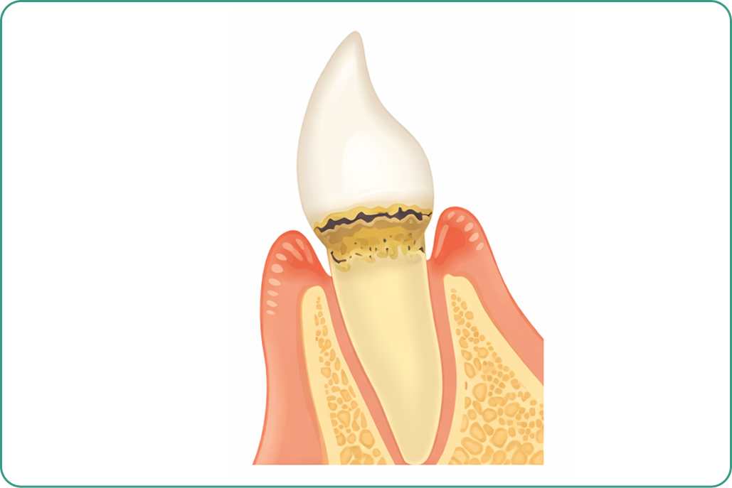 kourinshika-periodontal_symptoms_01