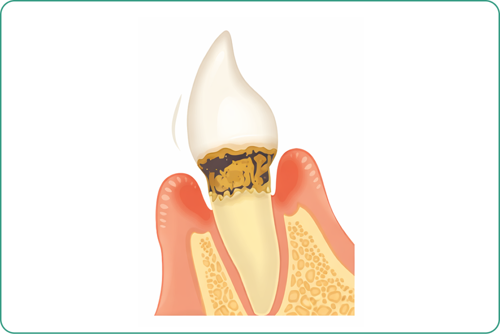 kourinshika-periodontal_symptoms_02
