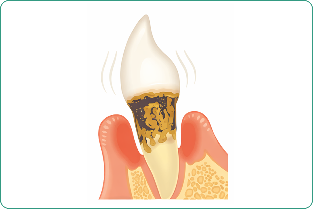 kourinshika-periodontal_symptoms_03